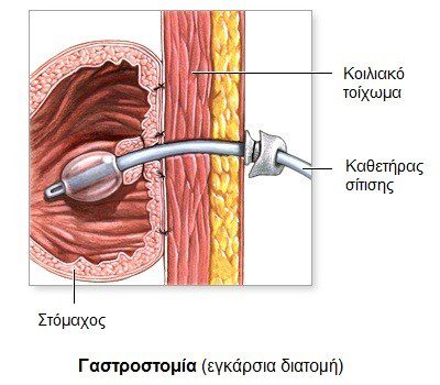 gastrostomia1