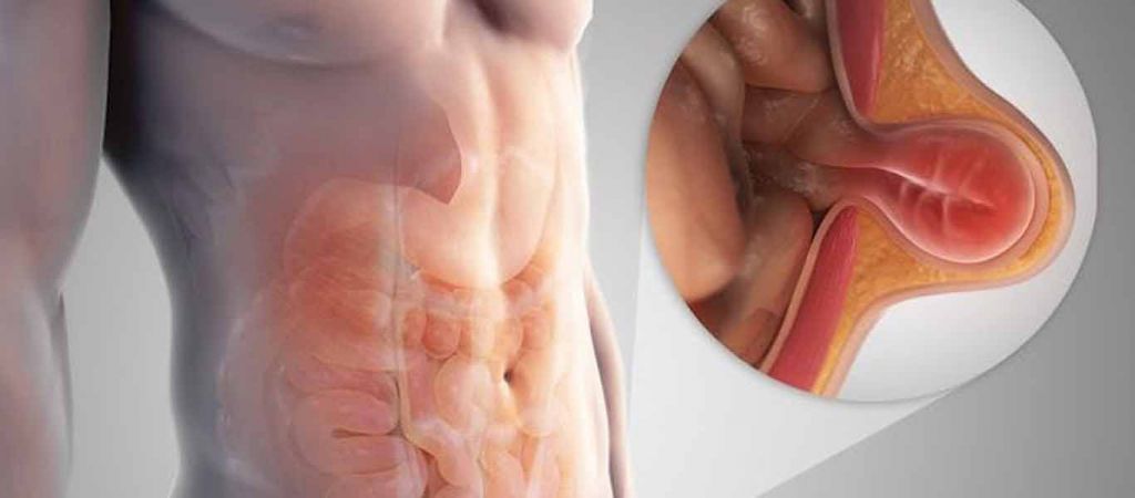 Βουβωνοκήλη