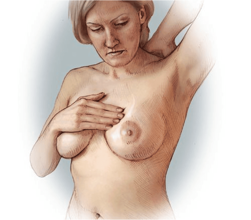 Μαστοδυνία