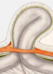 Ομφαλοκήλη2