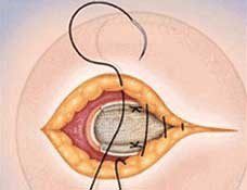 Ομφαλοκήλη3