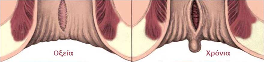 Ραγάδα δακτυλίου