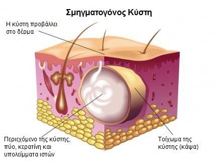 Σμηγματογόνος Κύστη