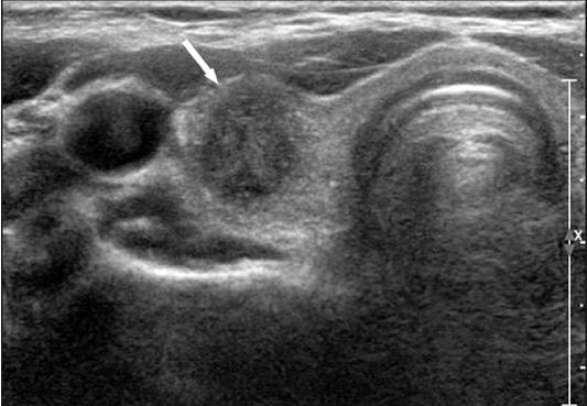 Κακοήθεις Όγκοι του Θυρεοειδούς