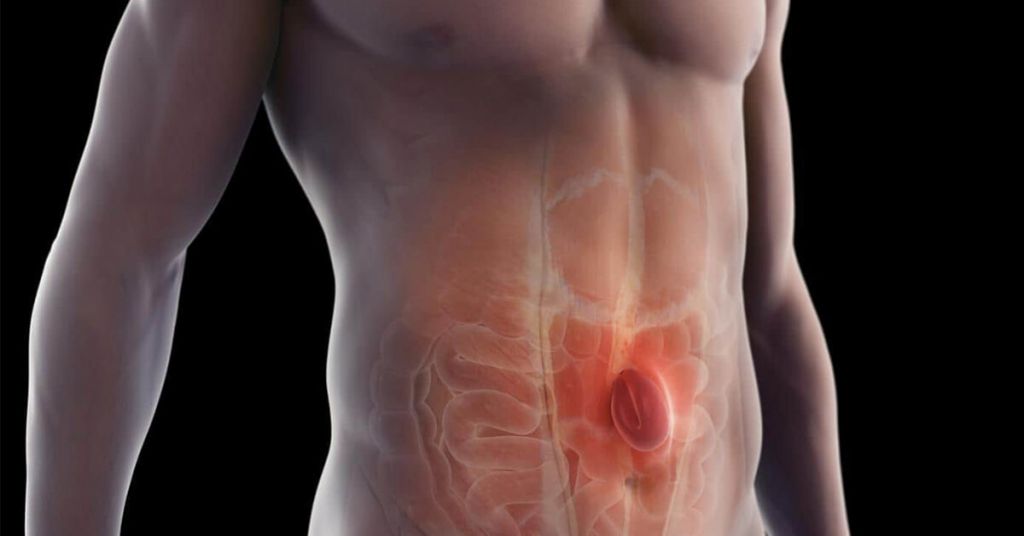 Θεραπεία Κήλης