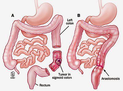 Λαπαροσκοπική κολεκτομή